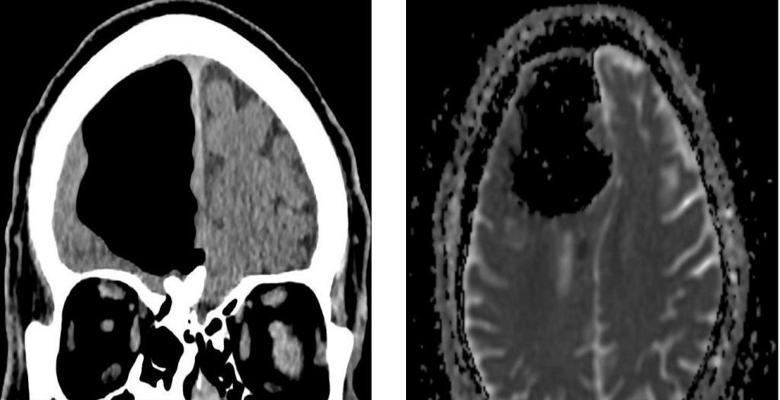 Anomália az ír agyában az orvosokat sújtotta