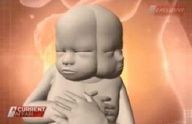 Az ausztrál kétfejű gyermek terhes. Video