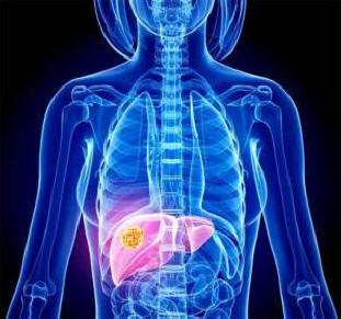 A gazdagok és a szegények különböző típusú rákban szenvednek