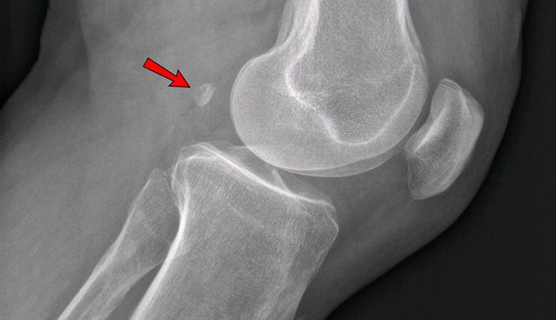 Fáj a térd? Talán