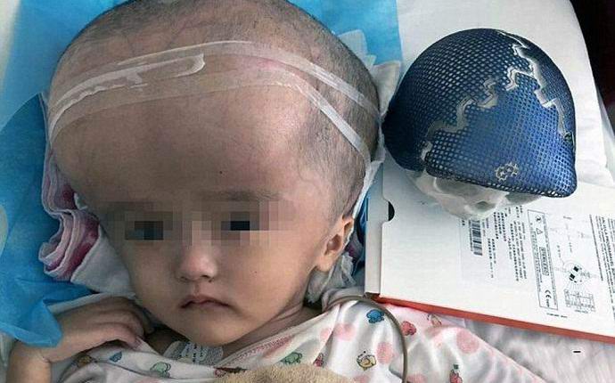 A nyomtatóra nyomtatott koponyát először egy emberbe implantálták.