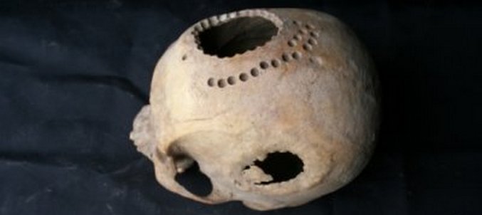 Szibéria ősi lakói tudták, hogyan kell agyműtétet végezni