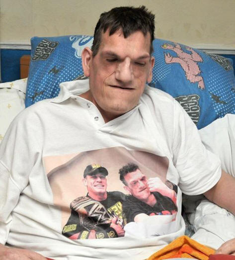 A Proteus-szindróma miatt az ember 240 cm-re nőtt