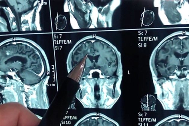 Egy kínai ember 30 évet élt, hatalmas féreggel a fejében.