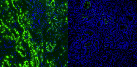 „Hasnyálmirigy-rák”