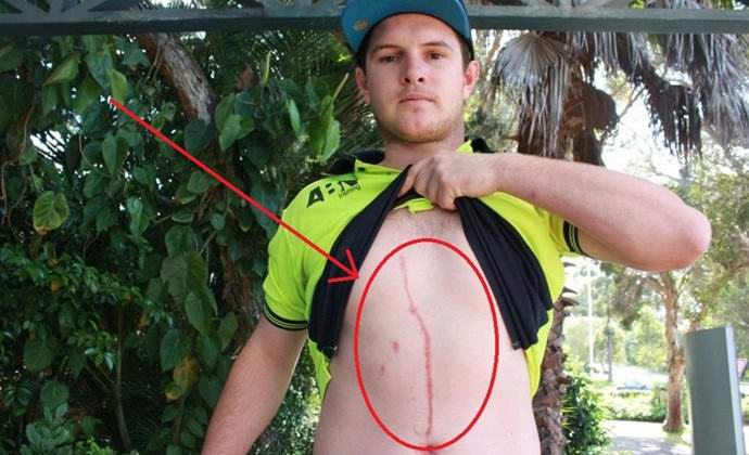 A pók mozdulatot adott az ausztrál hasában