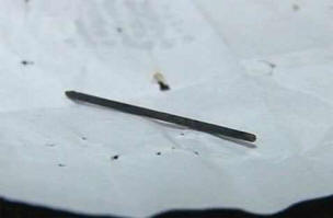 Az akupunktúrás tű áthaladt egy 40 éves férfi testén