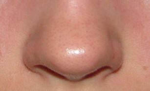 Őssejtkezelés után az amerikai orr nőtt fel