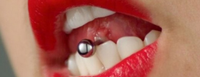 Megütötte a nyelvét - elvesztette az első fogait