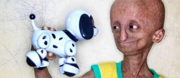 Egy ritka betegség egy tinédzserből egyfajta idegenré vált