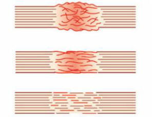 Biológiai fogantyú segítségével a szövetkárosodás gyorsan meggyógyul.
