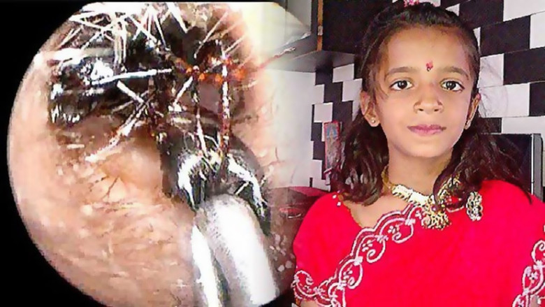 Furcsa orvosi esetek hangyákkal Indiában