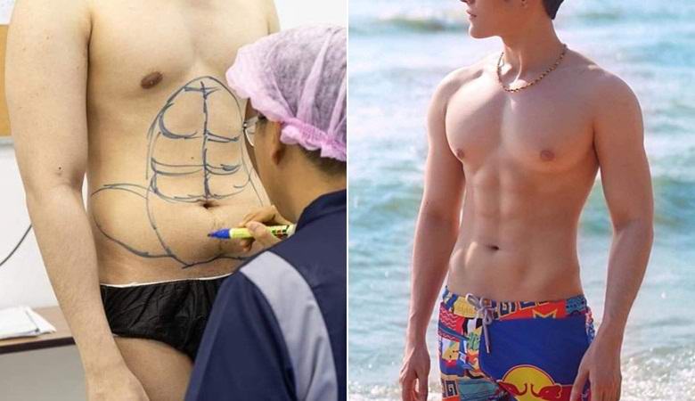 A thaiföldi kórház felfújt sajtónak tekinti a kövér betegeket