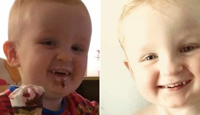 Egy angol fiúnak hirtelen agyarai vannak