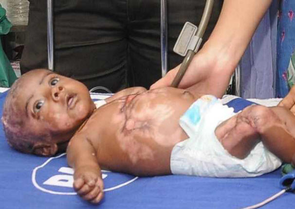 A második gyerek spontán égést szenved az indiai nőnél