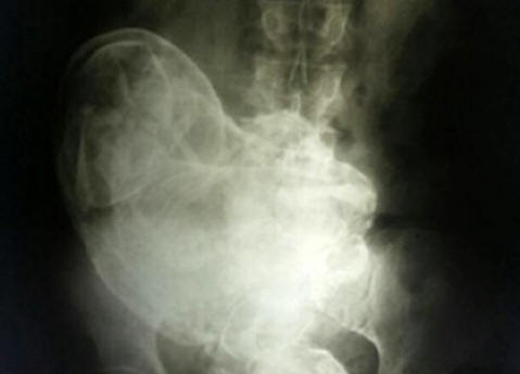 Brazíliában egy 44 éves nő holttestet vitt magába.