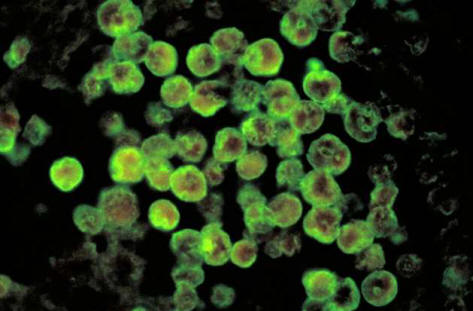 Louisiana-ban a vizet szennyezték az agyat fogyasztó amőbák.