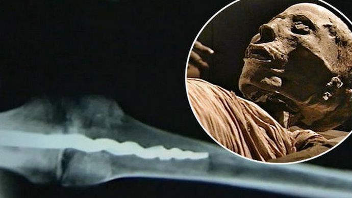 A múmiában egy modern forma ortopéd tűjét fedezték fel