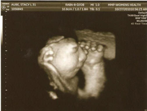 Az Egyesült Államokban a terhesség megmagyarázhatatlanul növekvő esetei ritka deformációjú magzatban