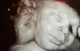 Kétfejű lány született az Egyesült Államokban