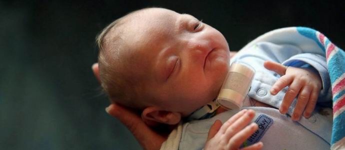 Egy ritka rendellenességű gyermek született az USA-ban