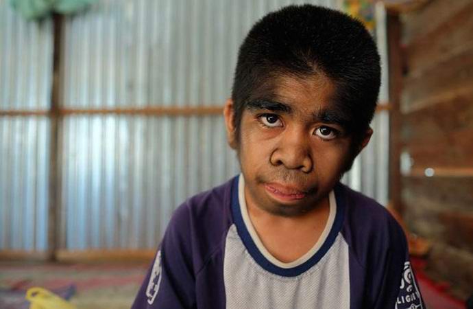 Egy vérfarkas szindrómás szőrös fiú megtagadja a kezelést