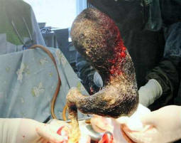 Az orvosok négy kilogramm hajot húztak ki egy porszívó lányból